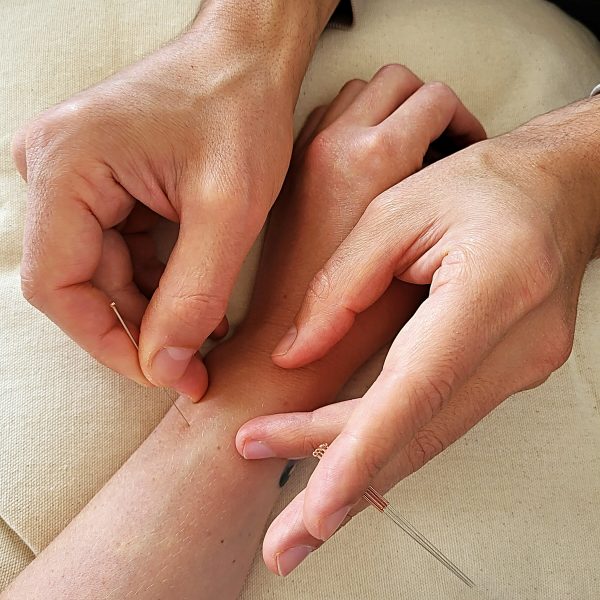 Akupunktur Arm